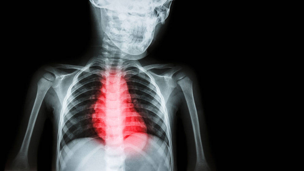 ischemic heart disease, cardiomyopathy