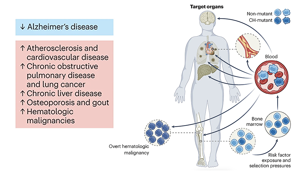 An example of research tying clonal hematopoiesis to protection against Alzheimer’s disease from The Jackson Laboratory's Jennifer Trowbridge.